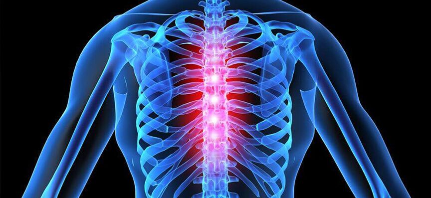 Exacerbarea osteocondrozei coloanei vertebrale toracice