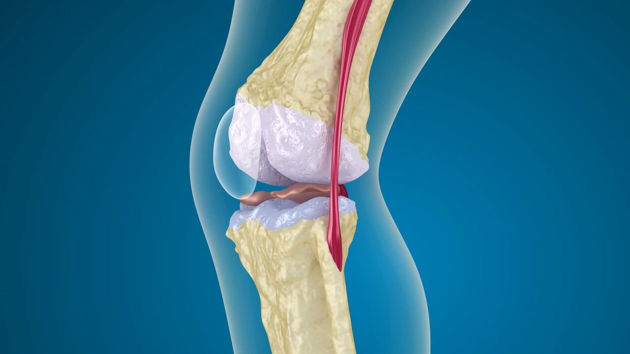 distrugerea articulației genunchiului cu artroză
