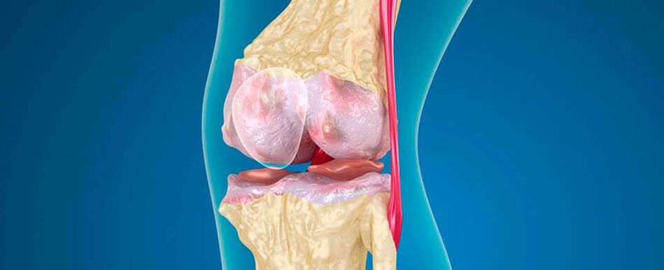 artroza genunchiului ca cauză a durerii