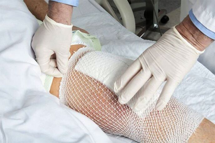 Compresa terapeutica pentru artroza articulatiei genunchiului