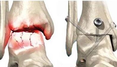 Tratamentul chirurgical al artrozei genunchiului