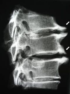 Osteofitele coloanei cervicale provoacă dureri de gât