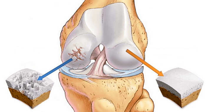 cartilaj sănătos și cartilaj afectat de artroză