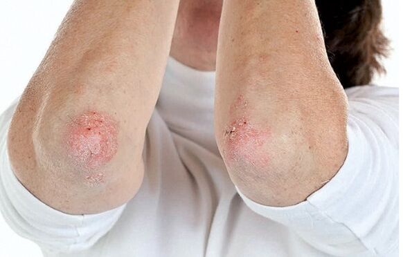 Persoanele cu psoriazis sunt susceptibile la artrita psoriazica
