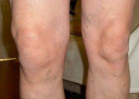 simptome ale genunchiului