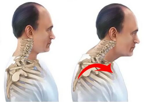 coloana vertebrală sănătoasă și bolnavă