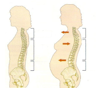 osteocondroză în timpul sarcinii
