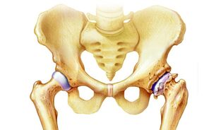 de ce apare artroza articulației șoldului